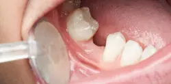 لا أسنان اصطناعية بعد اليوم.. اختراق علمي غير مسبوق سينهي معاناة من يعانون من فقدان الأسنان